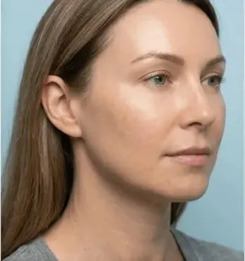 After — Procell microchanneling — deep scar improvement